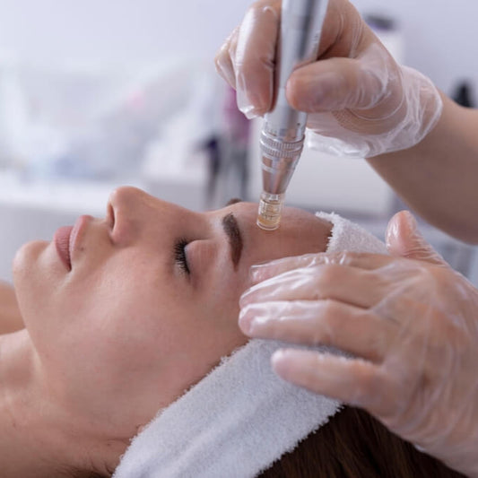 Acne Micro-Needle Treatment
