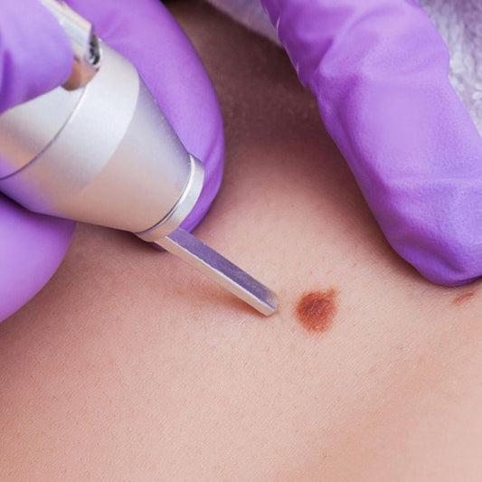 Mole Removal